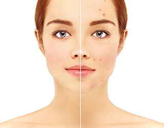 acne blog