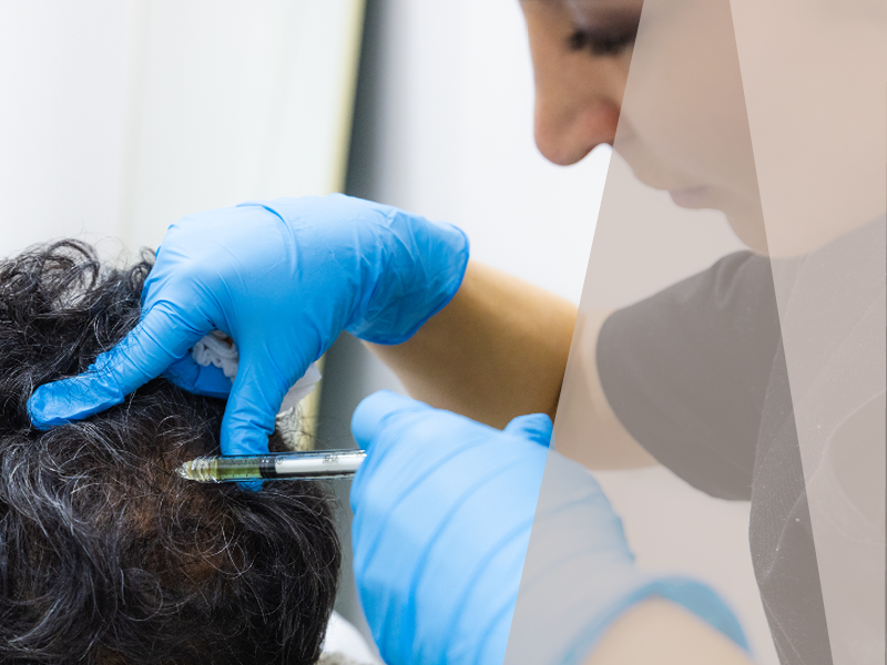 PRP Hair Loss Treatment