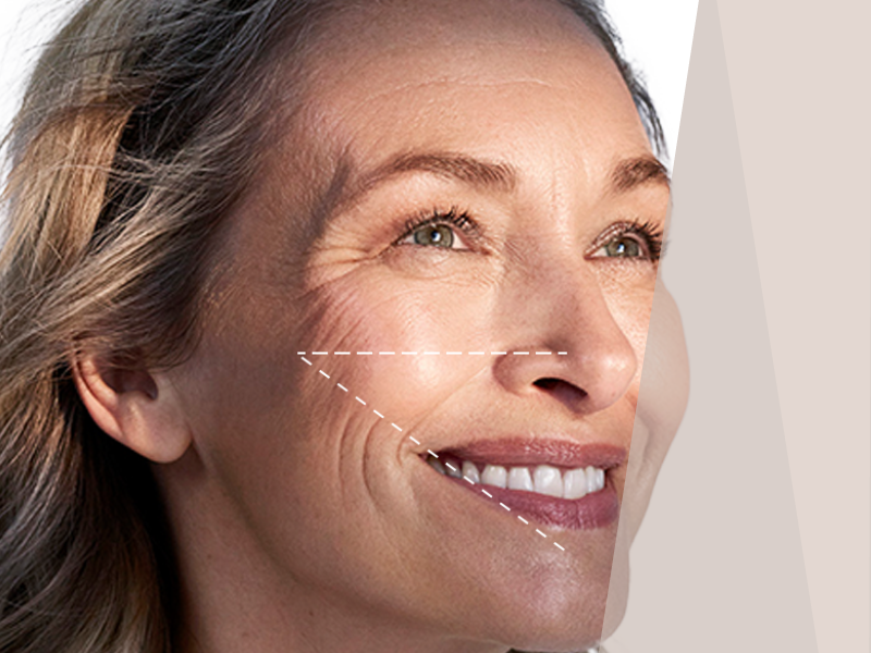 Silhouette Soft Thread Lift
